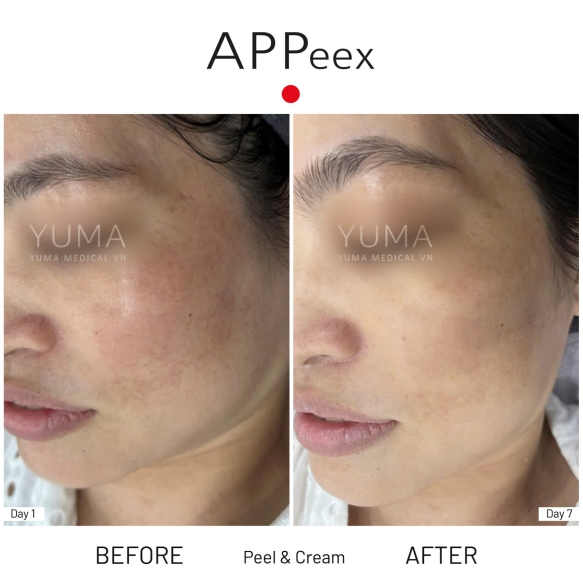 APPeex Peel