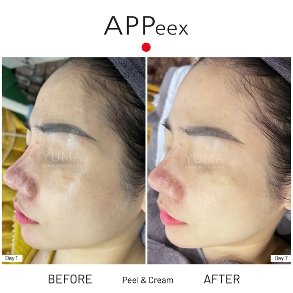APPeex Peel